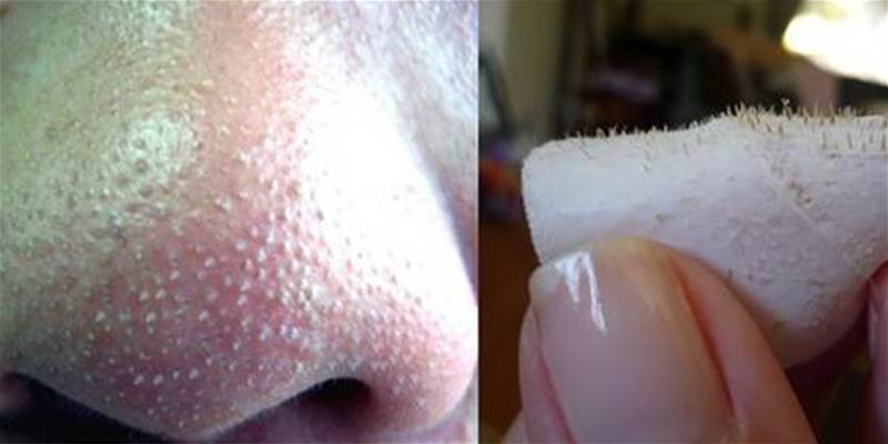 3 dicas naturais para eliminar os cravos no nariz em casa!